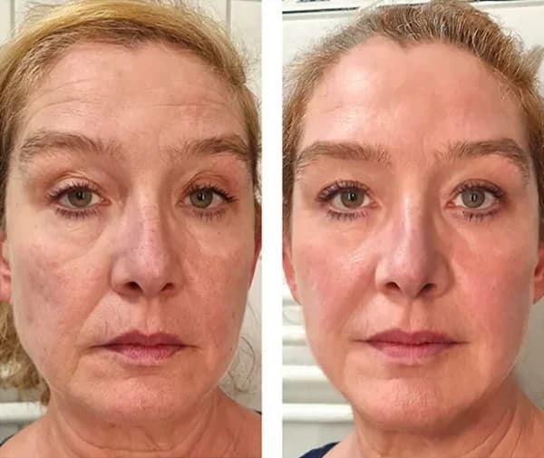 FACIAL ASYMMETRY after